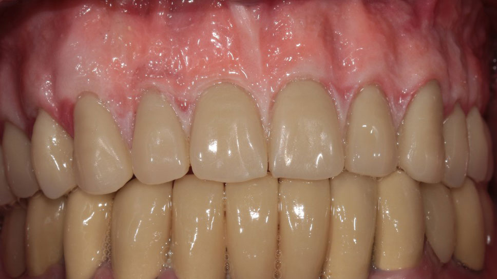 denture-2-e1601919563281