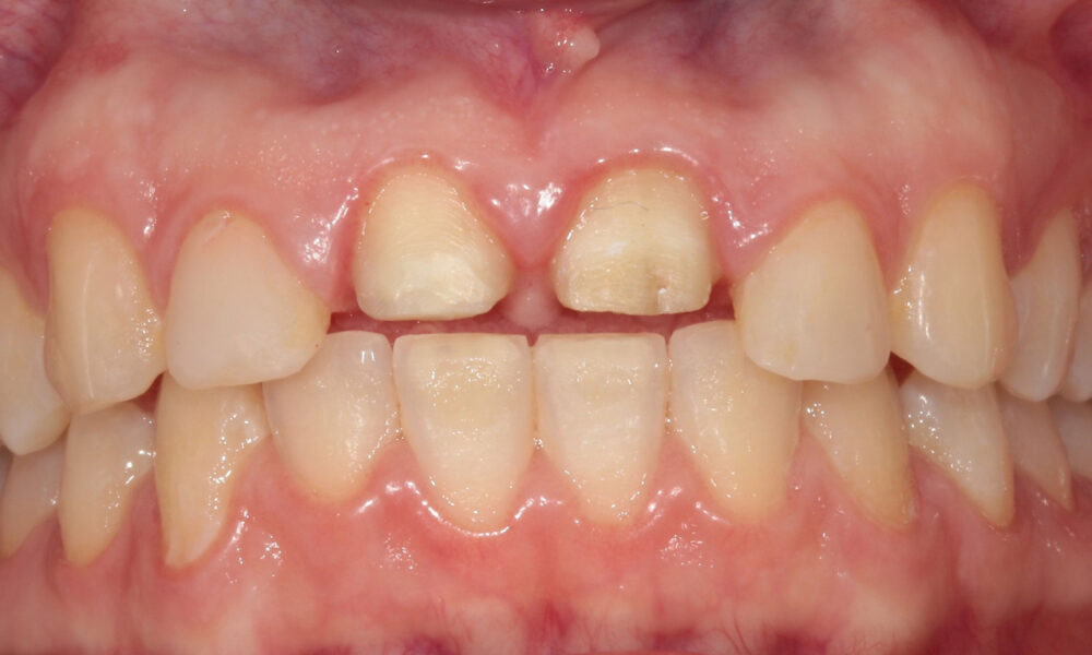 zircrowns1-e1603046850608